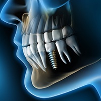 3D image of person with dental implant 