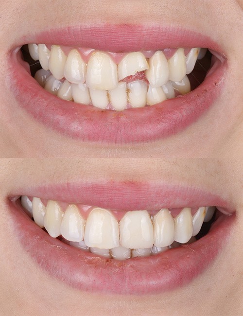 A before-and-after photo showing cosmetic bonding results
