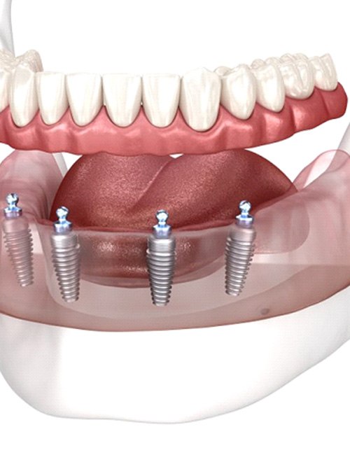 All-On-4 Implant Dentures