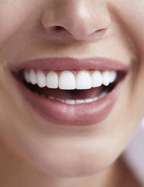 Patient's smile after gum recontouring