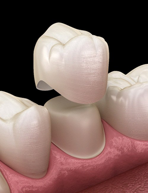 illustration of dental crowns in Temple