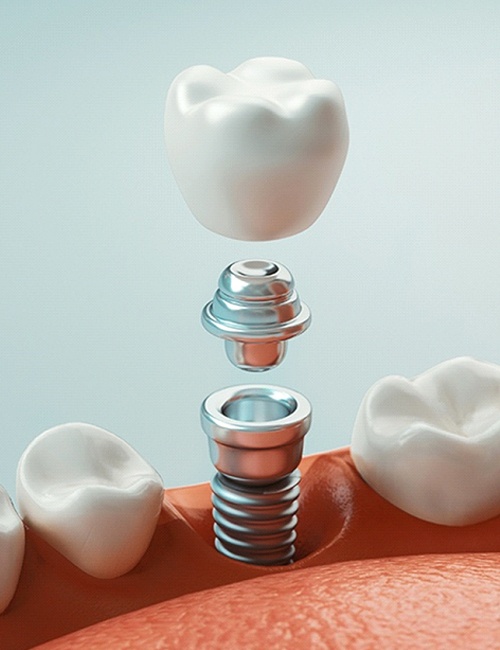 dental implant being placed in the lower jaw