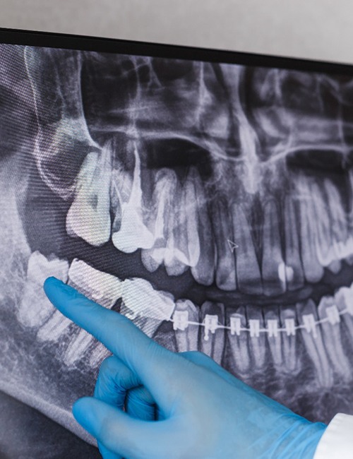 dentist explaining wisdom tooth extraction in Temple