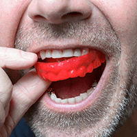 a man in Temple protecting his dental implants with mouthguards 