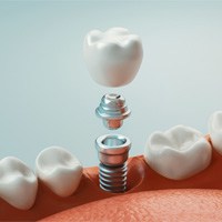 an illustration showing the parts of a dental implant