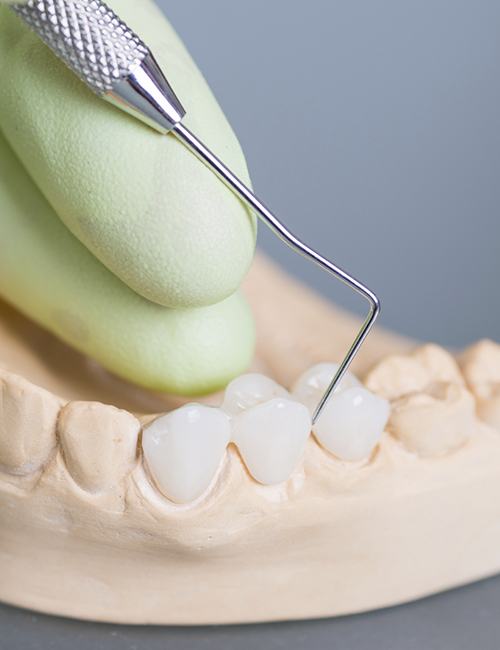 Model smile with dental bridge to replace missing teeth