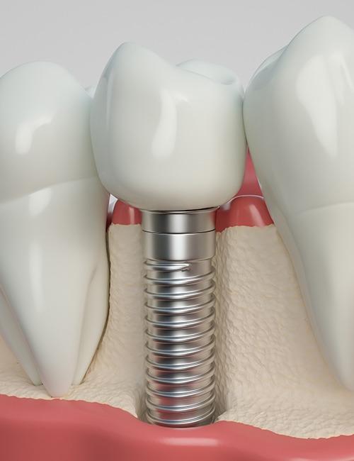 Animated dental implant supported dental crown