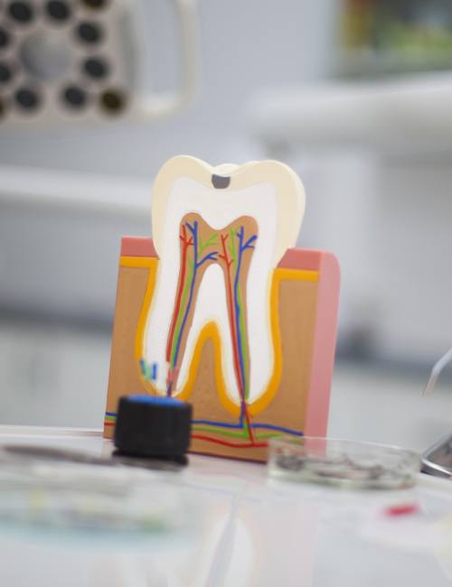 Model of the inside of a healthy tooth that doesn't need root canal therapy