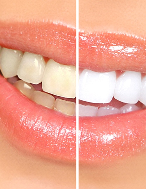 Before and after teeth whitening in Temple, TX