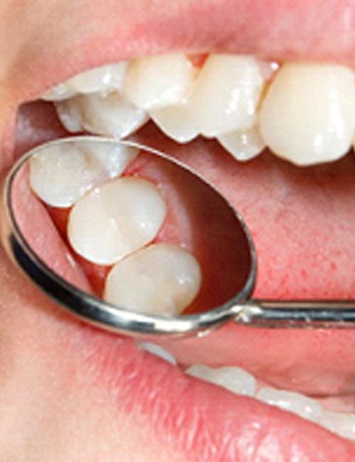 metal fillings vs tooth-colored fillings in Temple