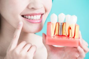 Dentist pointing to smile and holding model of dental implants