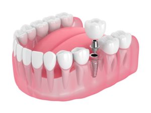 dental implants 101: the parts of a dental implant 