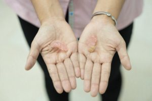 person holding a broken denture in their hands 