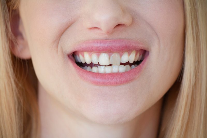 A woman with a gray-looking tooth