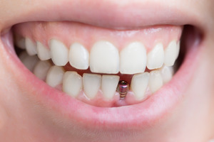 Close-up of mouth with unrestored dental implant