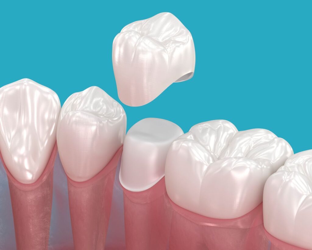 A CGI image of a dental crown fitting on a tooth