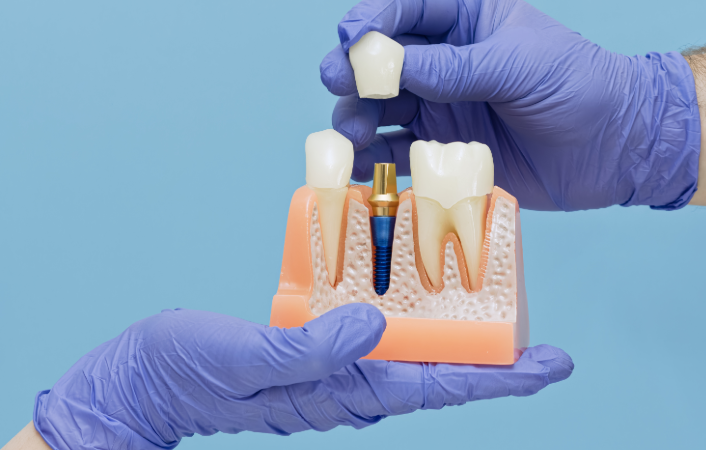 Dental implant model